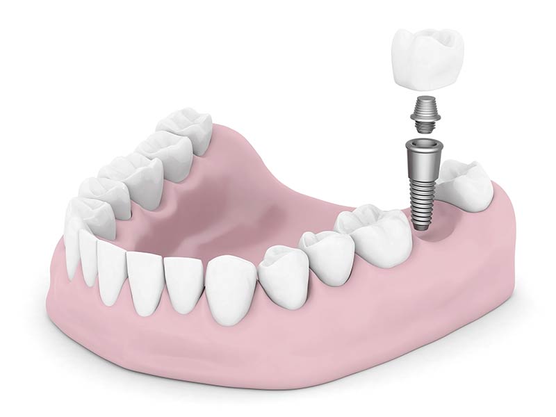 Dental Implant Rendering